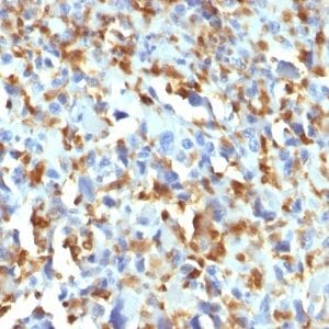 Formalin-fixed paraffin-embedded human Histiocytoma stained with Factor XIIIa Mouse Monoclonal Antibody (F13A1/1683).