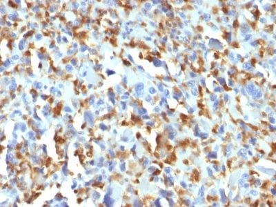 Formalin-fixed paraffin-embedded human Histiocytoma stained with Factor XIIIa Mouse Monoclonal Antibody (F13A1/1683).