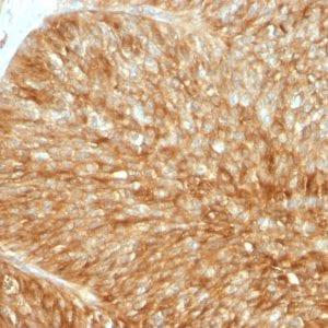 Formalin-fixed paraffin-embedded human Bladder Carcinoma stained with Beta-2-Microglobulin Rabbit Recombinant Monoclonal Antibody (B2M/1857R).