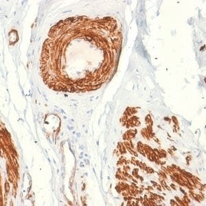 Formalin-fixed paraffin-embedded human Leiomyosarcoma stained with Caldesmon Mouse Recombinant Monoclonal Antibody (rCALD1/820).