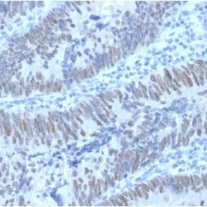 Formalin-fixed paraffin-embedded human Colon Carcinoma stained with CDX2 Mouse Monoclonal Antibody (PCRP-CDX2-1A3).