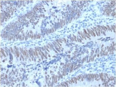Formalin-fixed paraffin-embedded human Colon Carcinoma stained with CDX2 Mouse Monoclonal Antibody (PCRP-CDX2-1A3).
