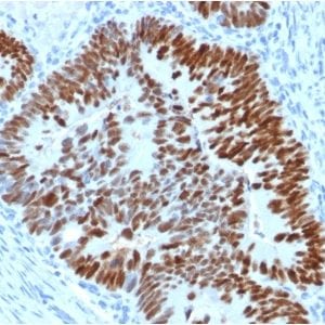 Formalin-fixed paraffin-embedded human Colon Carcinoma stained with p53 Mouse Monoclonal Antibody (PCRP-TP53-2A10).