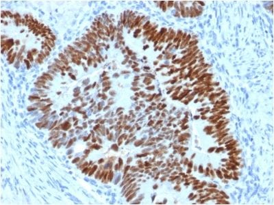 Formalin-fixed paraffin-embedded human Colon Carcinoma stained with p53 Mouse Monoclonal Antibody (PCRP-TP53-2A10).