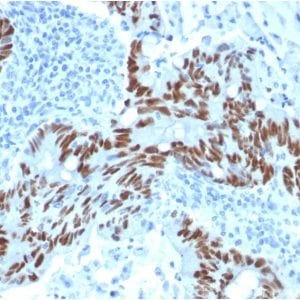 Formalin-fixed paraffin-embedded human Colon Carcinoma stained with p53 Mouse Monoclonal Antibody (PCRP-TP53-1F7).