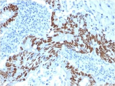 Formalin-fixed paraffin-embedded human Colon Carcinoma stained with p53 Mouse Monoclonal Antibody (PCRP-TP53-1F7).