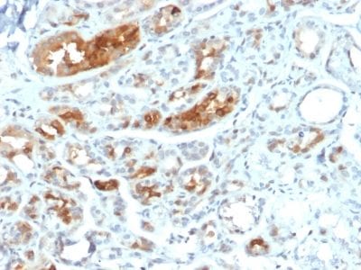 Formalin-fixed paraffin-embedded human Breast Carcinoma stained with Monospecific Mouse Monoclonal Antibody (MGB1/2000) to Mammaglobin.