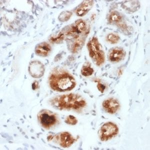 Formalin-fixed paraffin-embedded human Breast Carcinoma stained with Monospecific Mouse Monoclonal Antibody (MGB1/2000) to Mammaglobin.