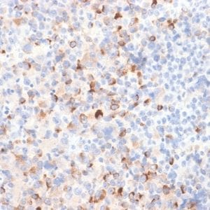 Formalin-fixed paraffin-embedded Melanoma stained with Tyrosinase Rabbit Recombinant Monoclonal Antibody (TYR/2024R).