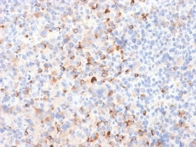 Formalin-fixed paraffin-embedded Melanoma stained with Tyrosinase Rabbit Recombinant Monoclonal Antibody (TYR/2024R).