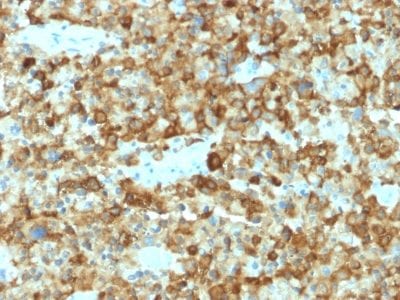 Formalin-fixed paraffin-embedded human Melanoma stained with gp100 Mouse Monoclonal Antibody (PMEL/2037).