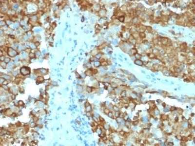 Formalin-fixed paraffin-embedded human Melanoma stained with gp100 Mouse Monoclonal Antibody (PMEL/2038).