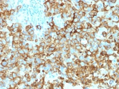 Formalin-fixed paraffin-embedded human Melanoma stained with gp100 Mouse Monoclonal Antibody (PMEL/2039).