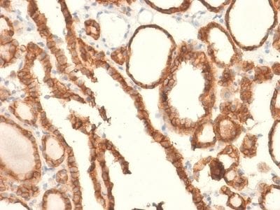 Formalin-fixed paraffin-embedded human Thyroid Carcinoma stained with EpCAM Rabbit Recombinant Monoclonal Antibody (EGP40/2041R).