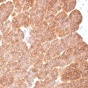 Formalin-fixed paraffin-embedded human Basal Cell Carcinoma stained with EpCAM Rabbit Recombinant Monoclonal Antibody (EGP40/2041R).