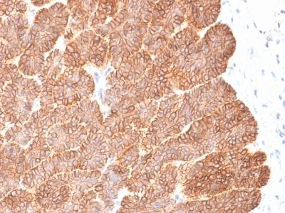 Formalin-fixed paraffin-embedded human Basal Cell Carcinoma stained with EpCAM Rabbit Recombinant Monoclonal Antibody (EGP40/2041R).