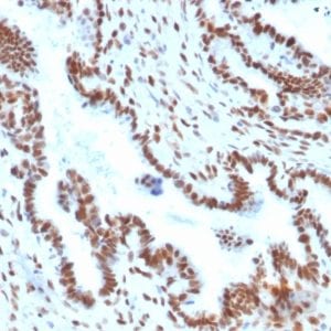 Formalin-fixed paraffin-embedded Human Endometrial Carcinoma stained with TLE1 Mouse Monoclonal Antibody (TLE1/2051).