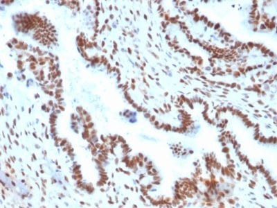 Formalin-fixed paraffin-embedded Human Endometrial Carcinoma stained with TLE1 Mouse Monoclonal Antibody (TLE1/2051).