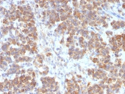 Formalin-fixed paraffin-embedded human Parathyroid Mass stained with VEGI Rabbit Recombinant Monoclonal Antibody (VEGI /2052R).