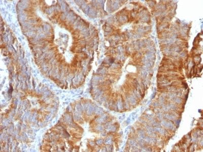 Formalin-fixed paraffin-embedded human Colon Carcinoma stained with VEGI Rabbit Recombinant Monoclonal Antibody (VEGI /2052R).