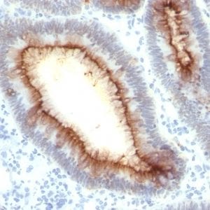 Formalin-fixed paraffin-embedded human Colon Carcinoma stained with CEA Mouse Recombinant Monoclonal Antibody (rC66/1009).