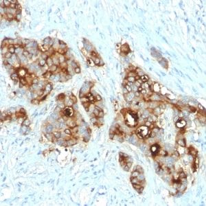 Formalin-fixed paraffin-embedded human Colon Carcinoma stained with CEA Rabbit Recombinant Monoclonal Antibody (C66/2055R).