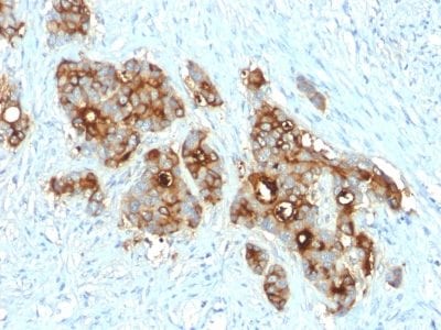Formalin-fixed paraffin-embedded human Colon Carcinoma stained with CEA Rabbit Recombinant Monoclonal Antibody (C66/2055R).