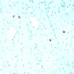 Formalin-fixed paraffin-embedded human Cervix stained with HPV-16 Mouse Recombinant Monoclonal Antibody (rHPV16L1/1058).