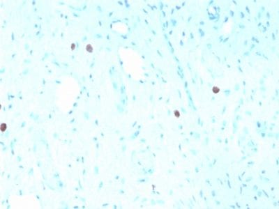 Formalin-fixed paraffin-embedded human Cervix stained with HPV-16 Mouse Recombinant Monoclonal Antibody (rHPV16L1/1058).