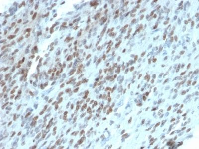 Formalin-fixed paraffin-embedded Human GIST stained with TLE1 Mouse Monoclonal Antibody (TLE1/2062).