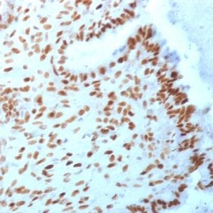 Formalin-fixed paraffin-embedded Human Endometrial Carcinoma stained with TLE1 Mouse Monoclonal Antibody (TLE1/2062).
