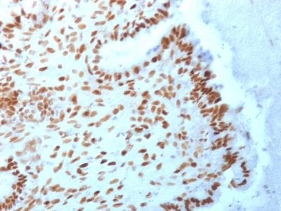 Formalin-fixed paraffin-embedded Human Endometrial Carcinoma stained with TLE1 Mouse Monoclonal Antibody (TLE1/2062).
