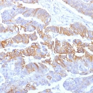 Formalin-fixed paraffin-embedded human Colon Carcinoma stained with E-Cadherin Mouse Recombinant Monoclonal Antibody (rCDH1/1525).