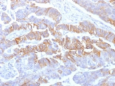 Formalin-fixed paraffin-embedded human Colon Carcinoma stained with E-Cadherin Mouse Recombinant Monoclonal Antibody (rCDH1/1525).