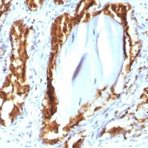 Formalin-fixed paraffin-embedded human Prostate Carcinoma stained with PSAP Mouse Recombinant Monoclonal Antibody (rACPP/1338).