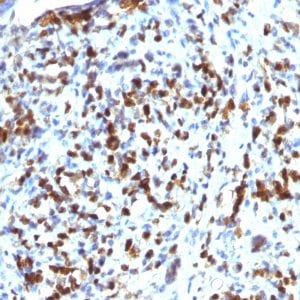 Formalin-fixed paraffin-embedded human Rhabdomyosarcoma stained with MyoD1 Mouse Monoclonal Antibody (MYOD1/2075R).