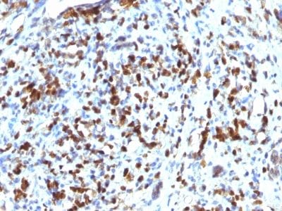 Formalin-fixed paraffin-embedded human Rhabdomyosarcoma stained with MyoD1 Mouse Monoclonal Antibody (MYOD1/2075R).