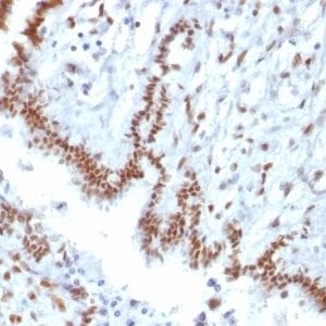 Formalin-fixed paraffin-embedded Human Endometrial Carcinoma stained with TLE1 Mouse Monoclonal Antibody (TLE1/2085).