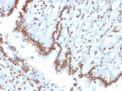 Formalin-fixed paraffin-embedded Human Endometrial Carcinoma stained with TLE1 Mouse Monoclonal Antibody (TLE1/2085).