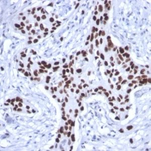 Formalin-fixed paraffin-embedded human Breast Carcinoma stained with p53 Mouse Recombinant Monoclonal Antibody (rTP53/1739)