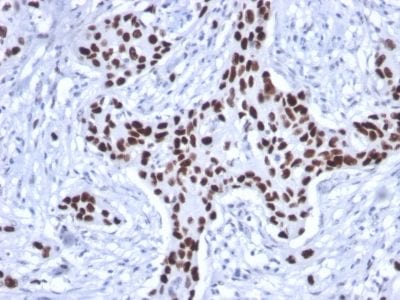 Formalin-fixed paraffin-embedded human Breast Carcinoma stained with p53 Mouse Recombinant Monoclonal Antibody (rTP53/1739)