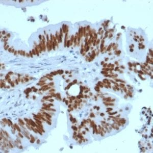 Formalin-fixed paraffin-embedded human Colon Carcinoma stained with p53 Recombinant Rabbit Monoclonal Antibody (TP53/2092R).