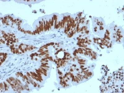 Formalin-fixed paraffin-embedded human Colon Carcinoma stained with p53 Recombinant Rabbit Monoclonal Antibody (TP53/2092R).