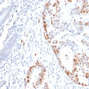 Formalin-paraffin human Colon Carcinoma stained with p53 Mouse Recombinant Monoclonal Antibody (rBP53-12).