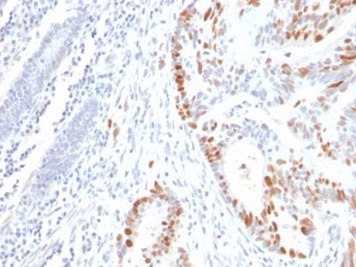 Formalin-paraffin human Colon Carcinoma stained with p53 Mouse Recombinant Monoclonal Antibody (rBP53-12).