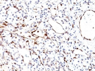 Formalin-fixed paraffin-embedded human Renal Cell Carcinoma stained with PTEN Mouse Monoclonal Antibody (PTEN/2110).