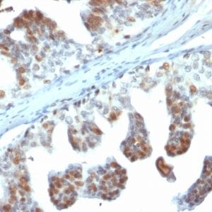 Formalin-fixed paraffin-embedded human Prostate Carcinoma stained with PTEN Mouse Monoclonal Antibody (PTEN/2110).