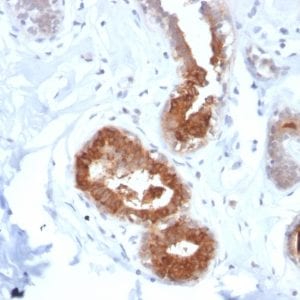 Formalin-fixed paraffin-embedded human Breast Carcinoma stained with Rabbit Recombinant Monoclonal Antibody (MGB1/2123R) to Mammaglobin.