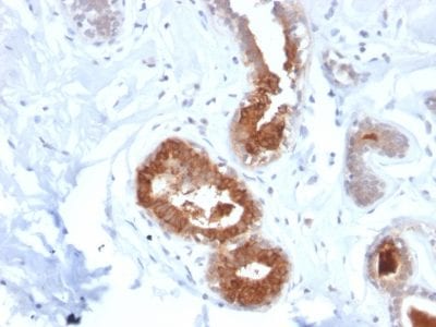 Formalin-fixed paraffin-embedded human Breast Carcinoma stained with Rabbit Recombinant Monoclonal Antibody (MGB1/2123R) to Mammaglobin.