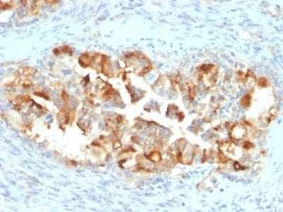 Formalin-fixed paraffin-embedded human Endometrial Carcinoma stained with Mesothelin Mouse Monoclonal Antibody (MSLN/2131).